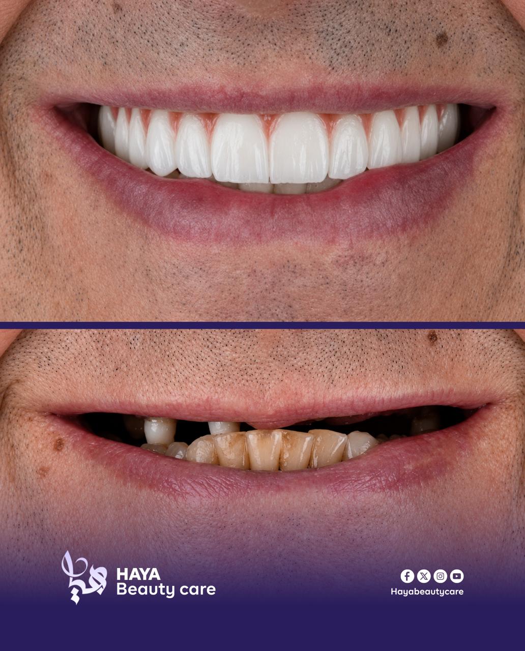 Smile makeover, before and after