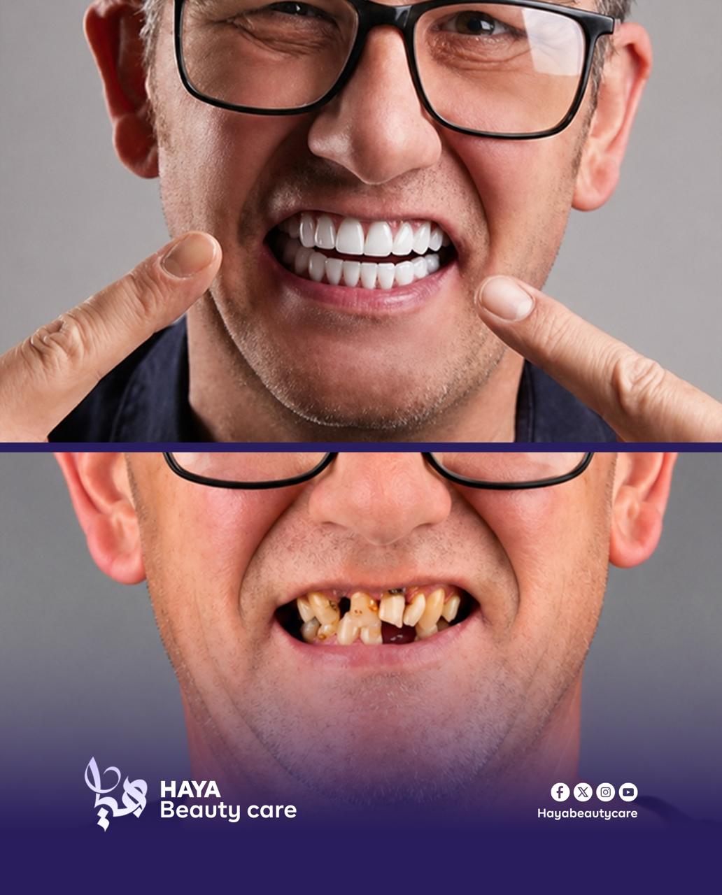 Full smile restoration, before and after